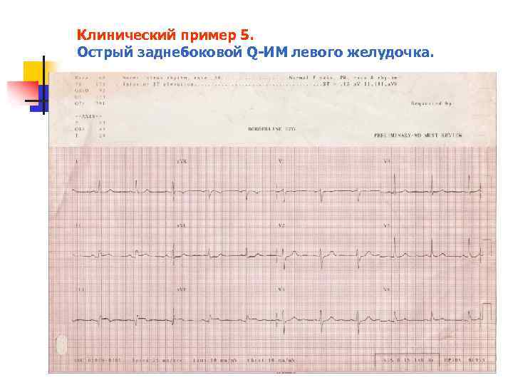 Клинический пример 5. Острый заднебоковой Q ИМ левого желудочка. 
