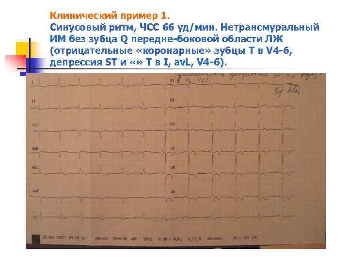 Клинический пример 1. Синусовый ритм, ЧСС 66 уд/мин. Нетрансмуральный ИМ без зубца Q передне