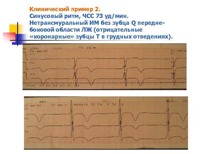 Клинический пример 2. Синусовый ритм, ЧСС 73 уд/мин. Нетрансмуральный ИМ без зубца Q передне