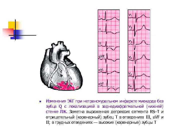 n Изменения ЭКГ при нетрансмуральном инфаркте миокарда без зубца Q с локализацией в заднедиафрагмальной