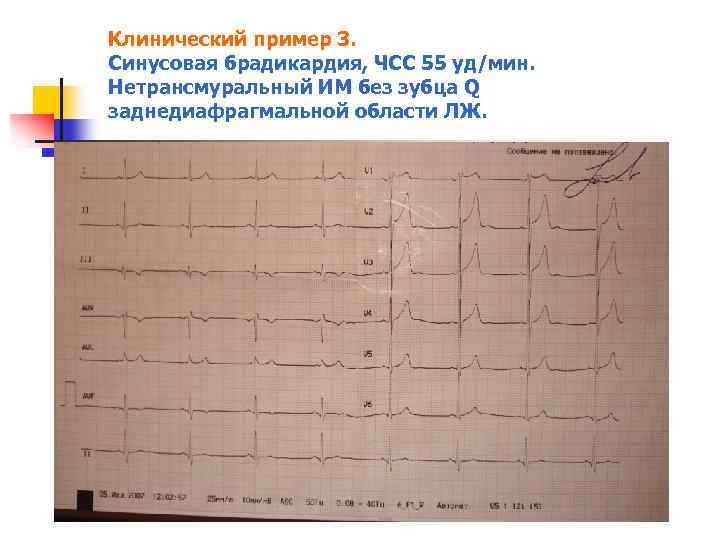 Клинический пример 3. Синусовая брадикардия, ЧСС 55 уд/мин. Нетрансмуральный ИМ без зубца Q заднедиафрагмальной