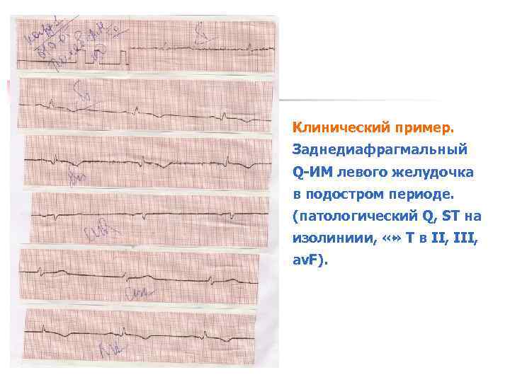 Клинический пример. Заднедиафрагмальный Q ИМ левого желудочка в подостром периоде. (патологический Q, ST на