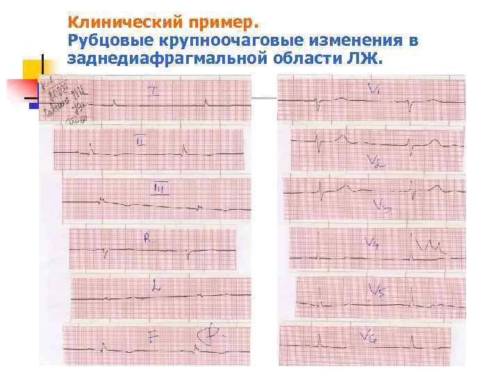 Клинический пример. Рубцовые крупноочаговые изменения в заднедиафрагмальной области ЛЖ. 