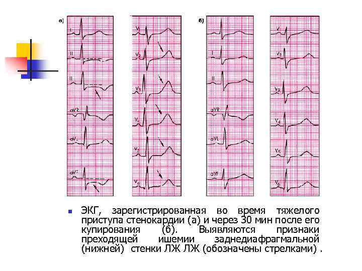 n ЭКГ, зарегистрированная во время тяжелого приступа стенокардии (а) и через 30 мин после