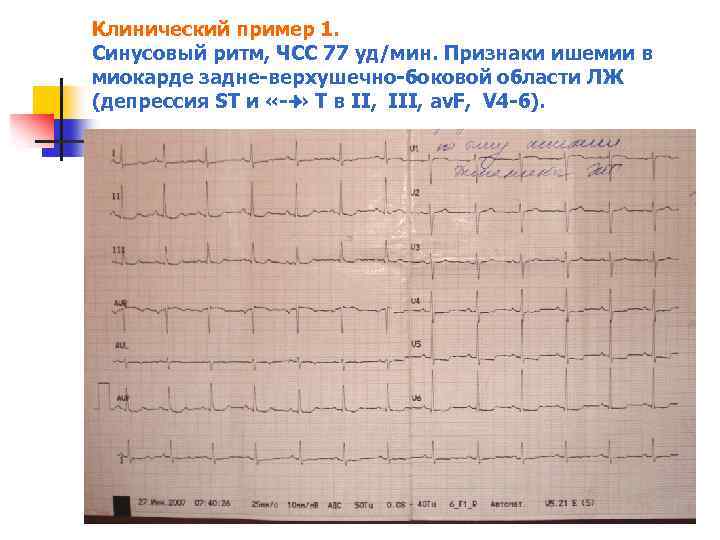 Клинический пример 1. Синусовый ритм, ЧСС 77 уд/мин. Признаки ишемии в миокарде задне верхушечно