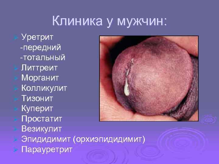 Клиника у мужчин: Уретрит -передний -тотальный Ø Литтреит Ø Морганит Ø Колликулит Ø Тизонит