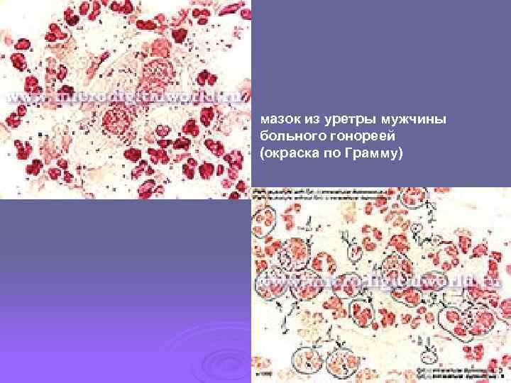 мазок из уретры мужчины больного гонореей (окраска по Грамму) 