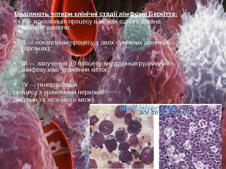 Виділяють чотири клінічні стадії лімфоми Беркітта: • І — локалізація процесу в межах одного