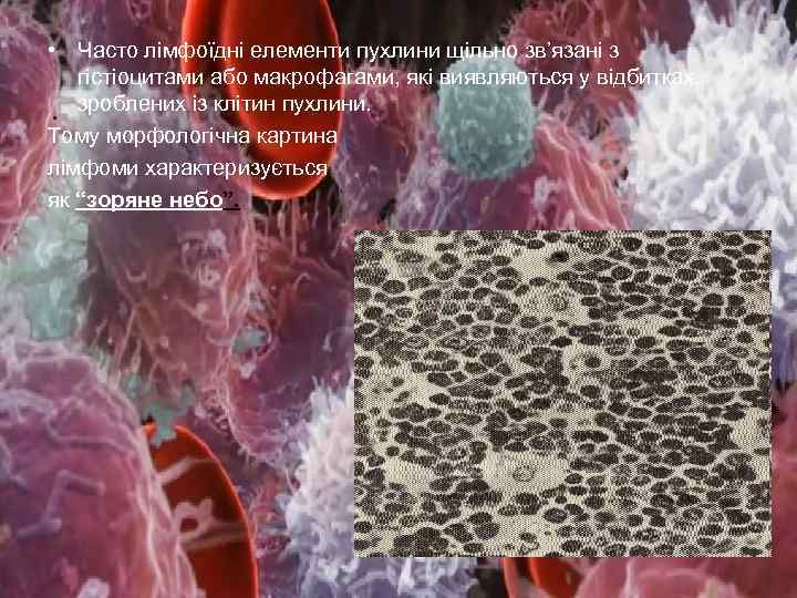  • Часто лімфоїдні елементи пухлини щільно зв’язані з гістіоцитами або макрофагами, які виявляються