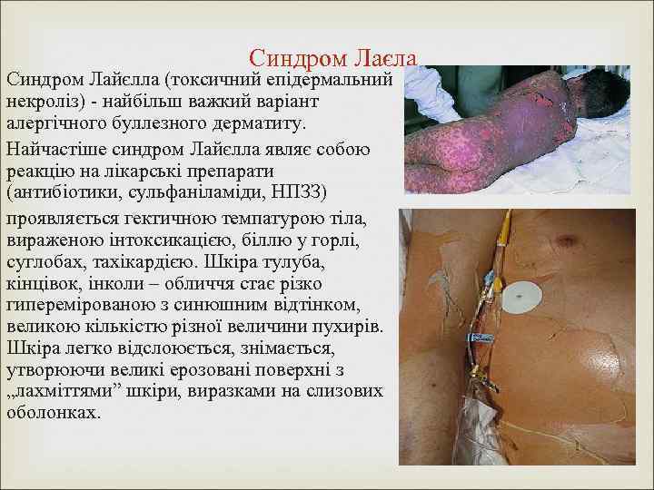 Синдром Лаєла Синдром Лайєлла (токсичний епідермальний некроліз) - найбільш важкий варіант алергічного буллезного дерматиту.