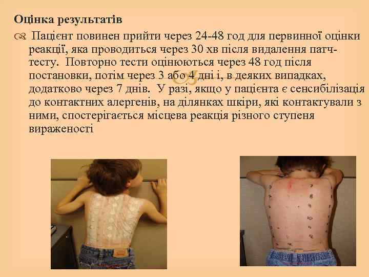 Оцінка результатів Пацієнт повинен прийти через 24 -48 год для первинної оцінки реакції, яка