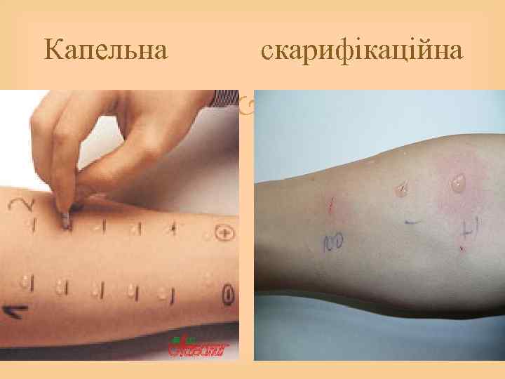 Капельна скарифікаційна 