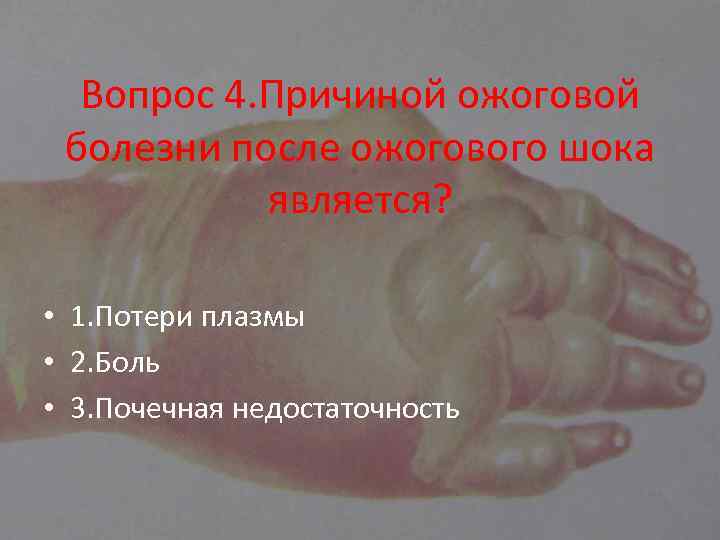 Вопрос 4. Причиной ожоговой болезни после ожогового шока является? • 1. Потери плазмы •