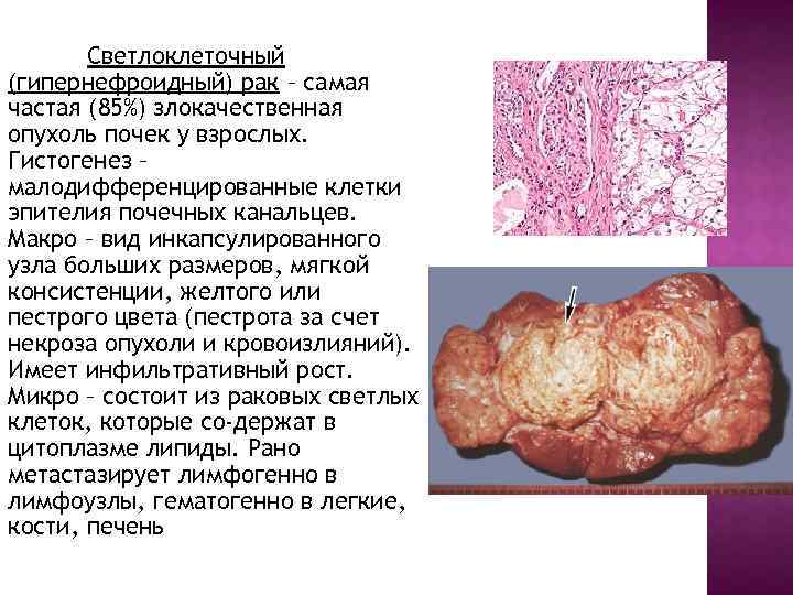 Светлоклеточный (гипернефроидный) рак – самая частая (85%) злокачественная опухоль почек у взрослых. Гистогенез –