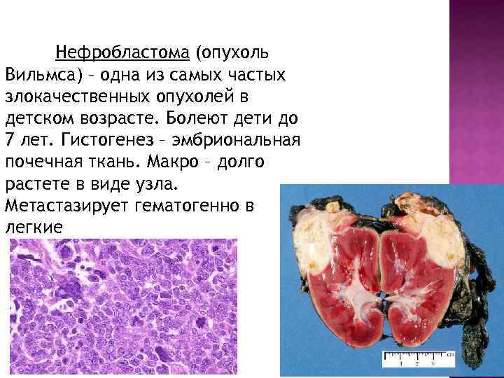 Нефробластома (опухоль Вильмса) – одна из самых частых злокачественных опухолей в детском возрасте. Болеют