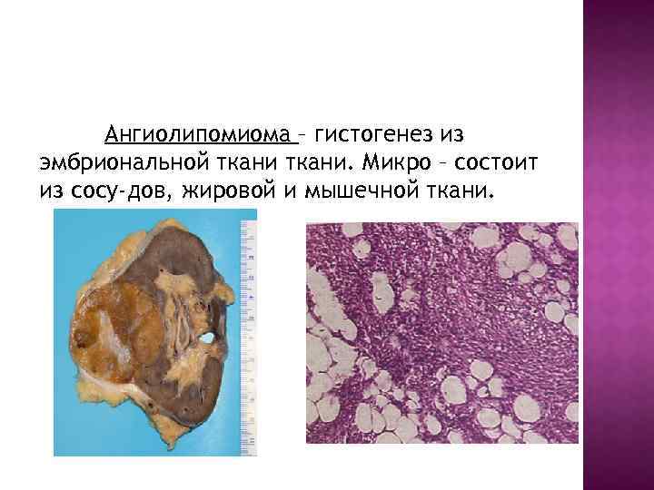 Ангиолипомиома – гистогенез из эмбриональной ткани. Микро – состоит из сосу-дов, жировой и мышечной