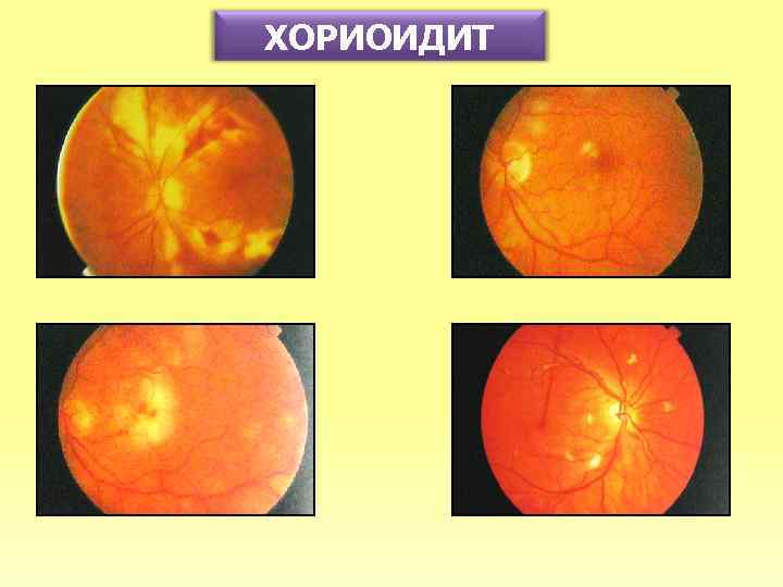 ХОРИОИДИТ 