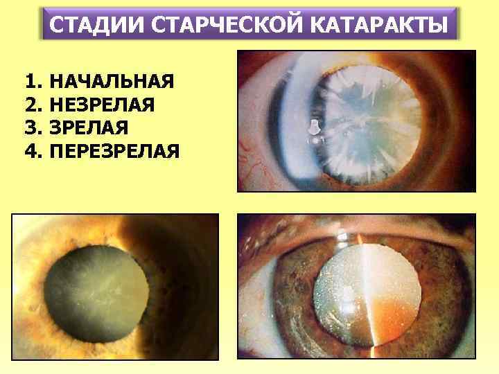 СТАДИИ СТАРЧЕСКОЙ КАТАРАКТЫ 1. 2. 3. 4. НАЧАЛЬНАЯ НЕЗРЕЛАЯ ПЕРЕЗРЕЛАЯ 