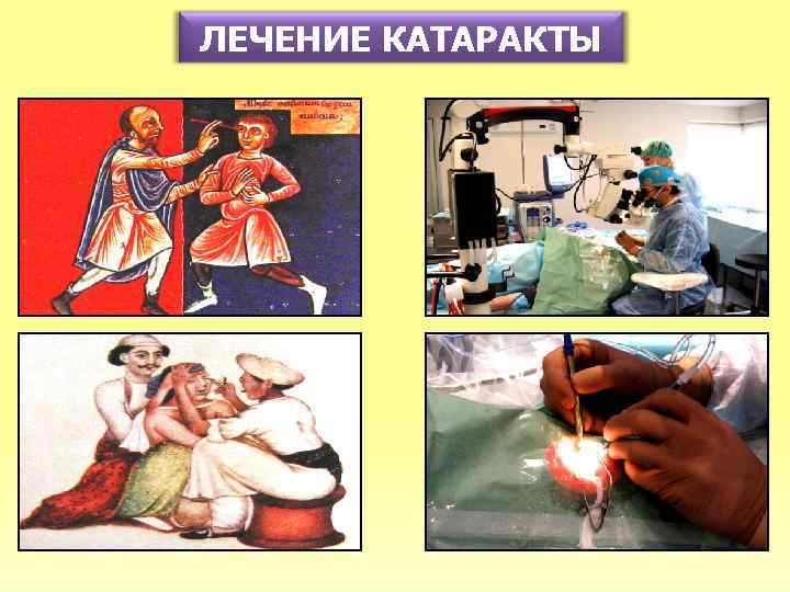 ЛЕЧЕНИЕ КАТАРАКТЫ 