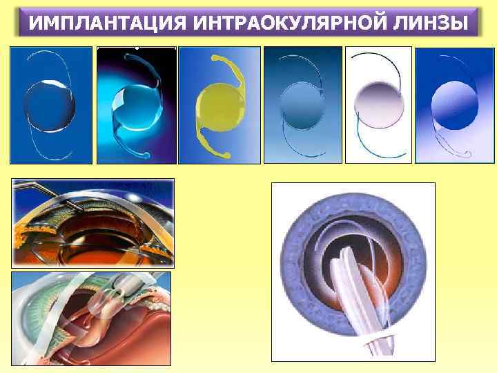 ИМПЛАНТАЦИЯ ИНТРАОКУЛЯРНОЙ ЛИНЗЫ 