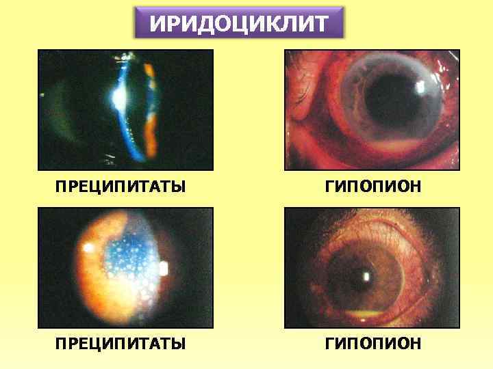 ИРИДОЦИКЛИТ ПРЕЦИПИТАТЫ ГИПОПИОН 
