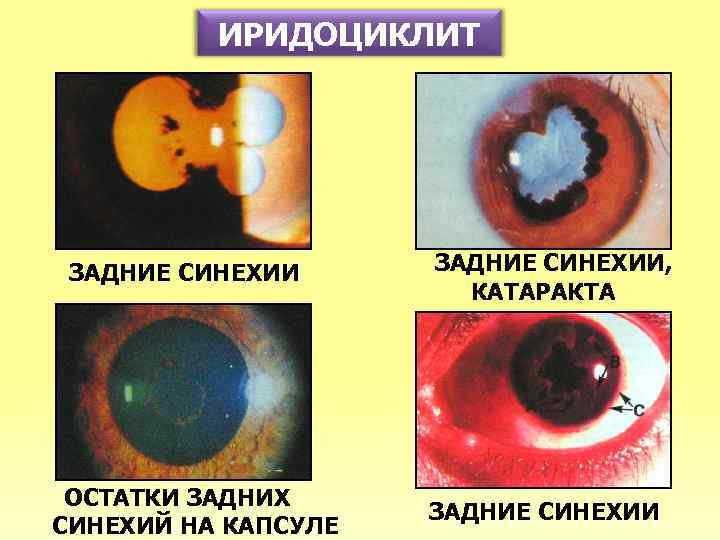 ИРИДОЦИКЛИТ ЗАДНИЕ СИНЕХИИ ОСТАТКИ ЗАДНИХ СИНЕХИЙ НА КАПСУЛЕ ЗАДНИЕ СИНЕХИИ, КАТАРАКТА ЗАДНИЕ СИНЕХИИ 