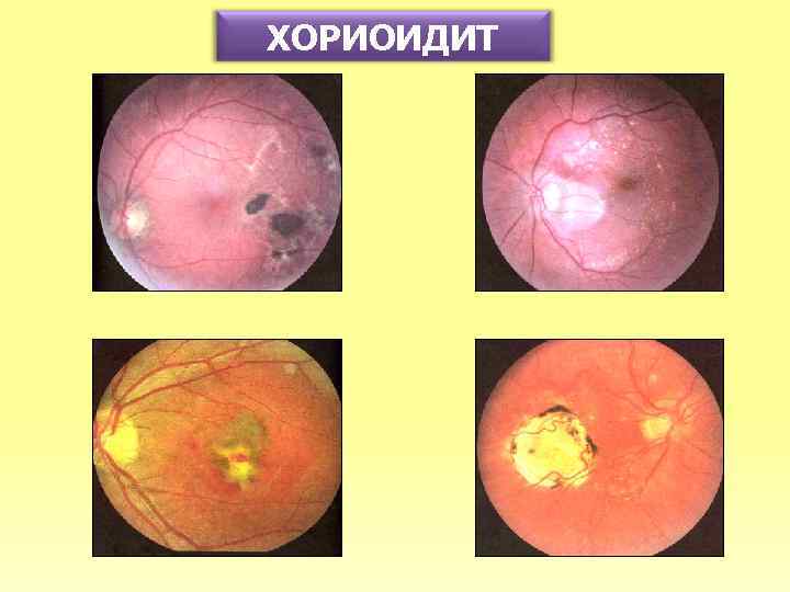 ХОРИОИДИТ 