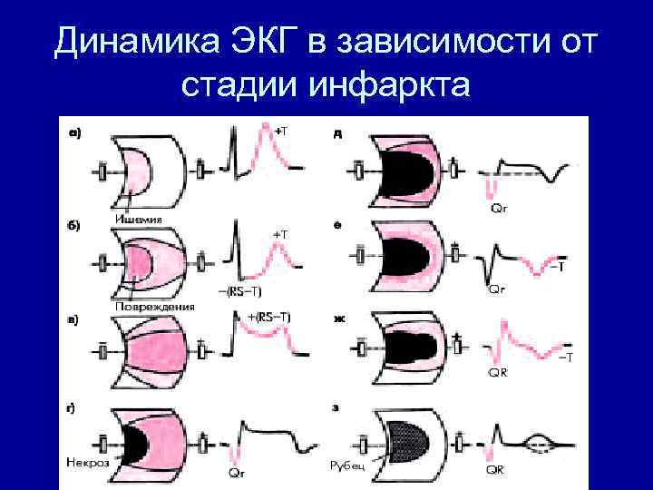 Динамика ЭКГ в зависимости от стадии инфаркта 