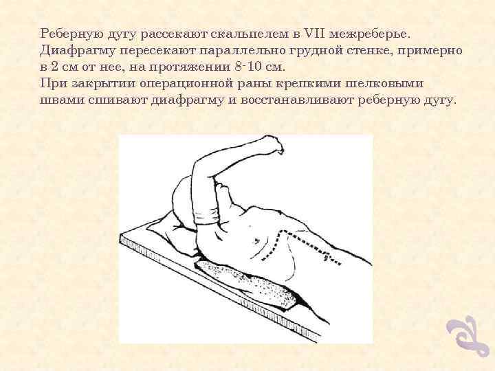 Реберную дугу рассекают скальпелем в VII межреберье. Диафрагму пересекают параллельно грудной стенке, примерно в