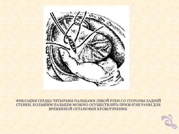  ФИКСАЦИЯ СЕРДЦА ЧЕТЫРЬМЯ ПАЛЬЦАМИ ЛЕВОЙ РУКИ СО СТОРОНЫ ЗАДНЕЙ СТЕНКИ. БОЛЬШИМ ПАЛЬЦЕМ МОЖНО