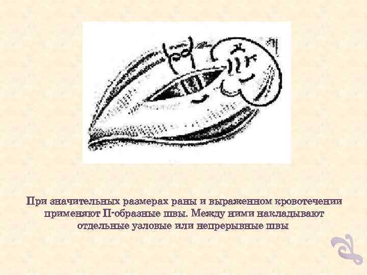 Сердечная рана 6. Техника ушивания РАН сердца. При ушивании раны сердца накладываются швы.