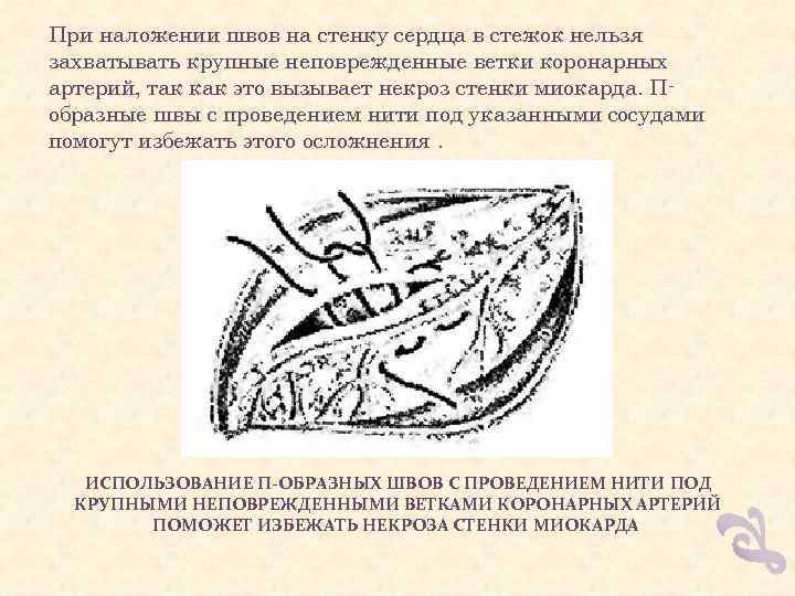 При наложении швов на стенку сердца в стежок нельзя захватывать крупные неповрежденные ветки коронарных