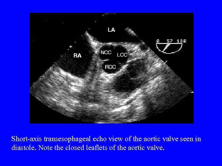 Short-axis transesophageal echo view of the aortic valve seen in diastole. Note the closed