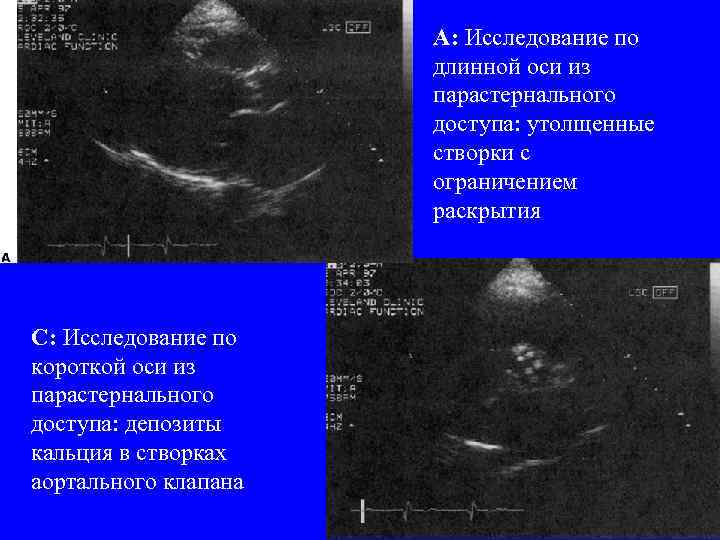 A: Исследование по длинной оси из парастернального доступа: утолщенные створки с ограничением раскрытия C: