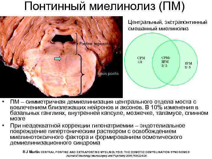 Понтинный миелинолиз (ПМ) Центральный, экстрапонтинный смешанный миелинолиз • ПМ – симметричная демиелинизация центрального отдела