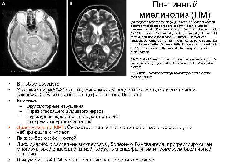 Понтинный миелинолиз (ПМ) (A) Magnetic resonance image (MRI) of a 57 year old woman