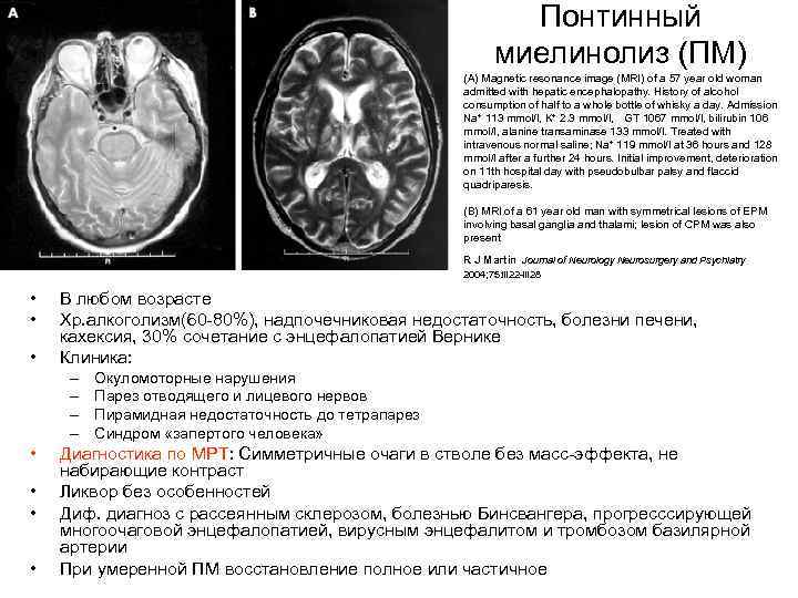 Центральный понтинный миелинолиз