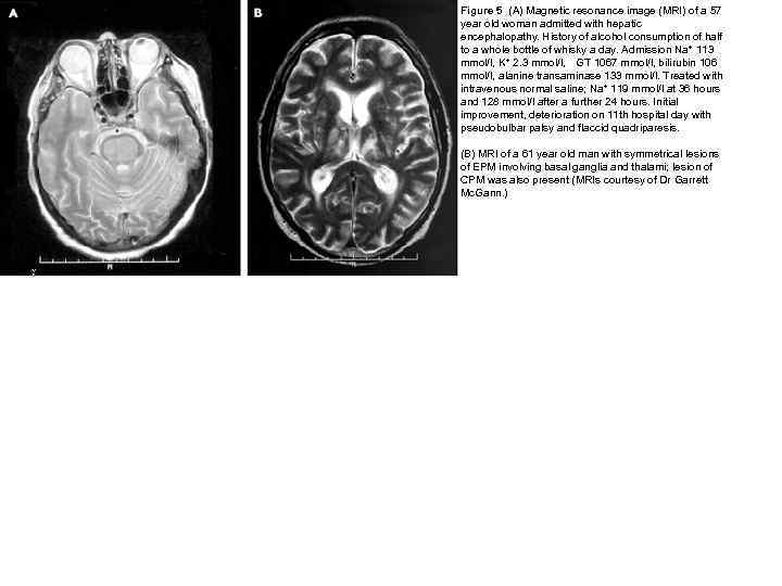 Figure 5 (A) Magnetic resonance image (MRI) of a 57 year old woman admitted
