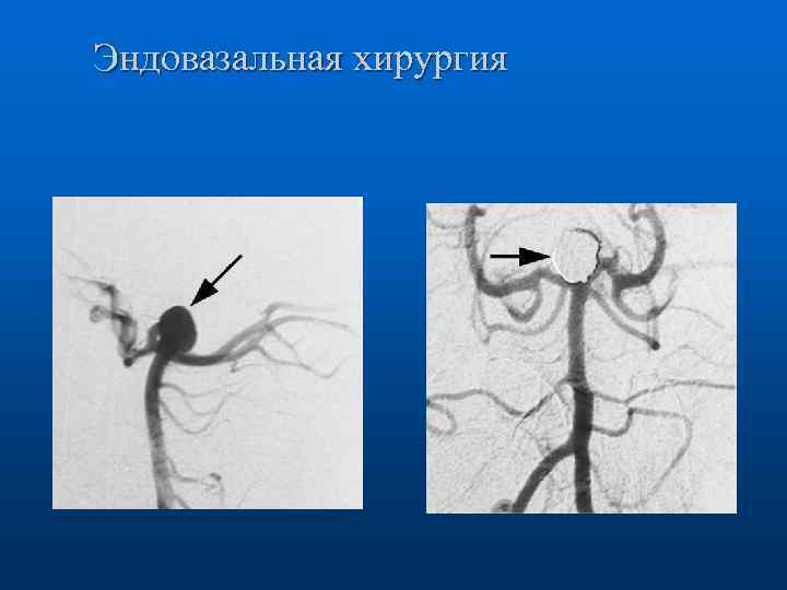 Эндовазальная хирургия 
