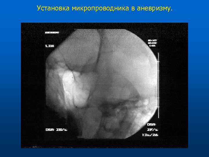 Установка микропроводника в аневризму. 