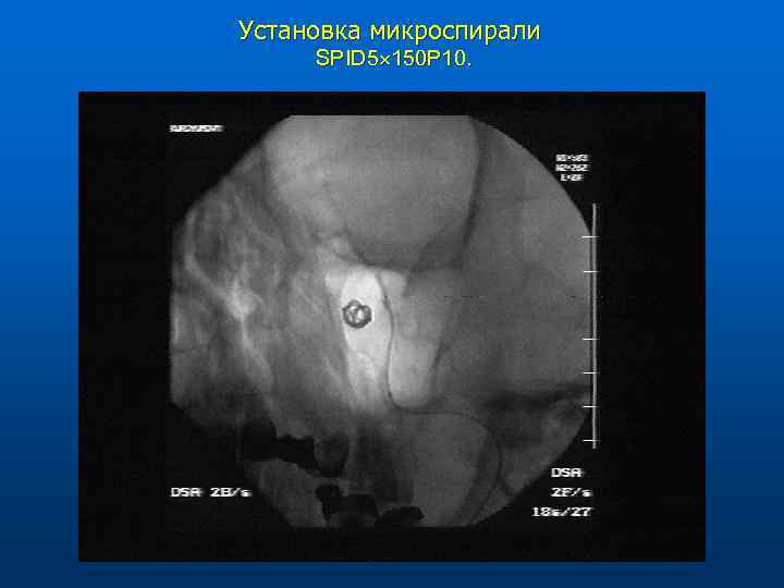 Установка микроспирали SPID 5 150 P 10. 