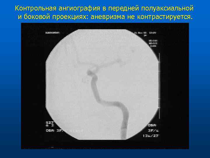 Контрольная ангиография в передней полуаксиальной и боковой проекциях: аневризма не контрастируется. 