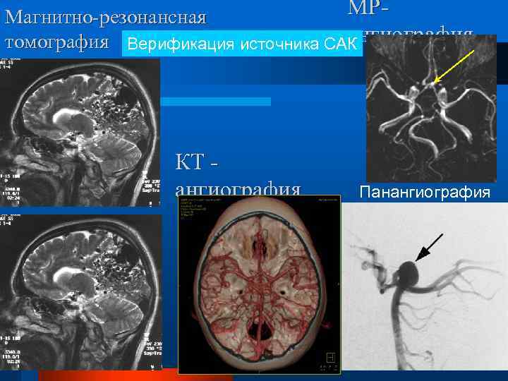 МРМагнитно-резонансная ангиография томография Верификация источника САК КТ ангиография Панангиография 