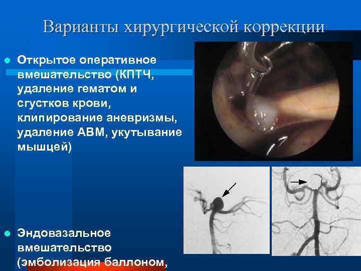 Варианты хирургической коррекции l Открытое оперативное вмешательство (КПТЧ, удаление гематом и сгустков крови, клипирование