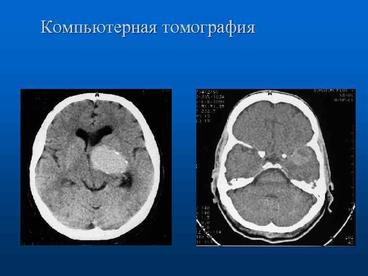 Компьютерная томография 