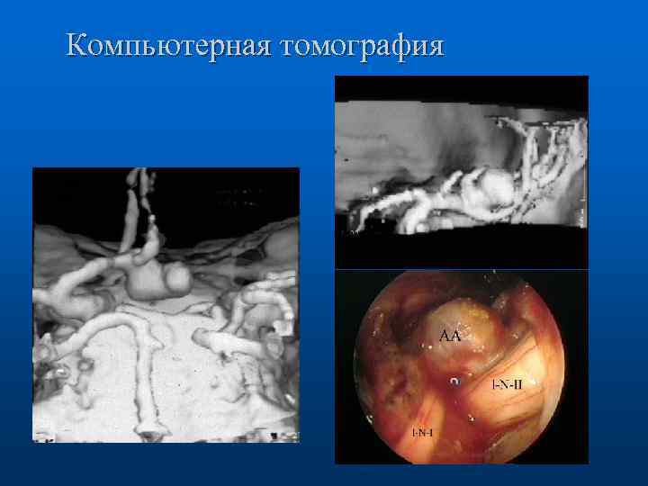 Компьютерная томография 
