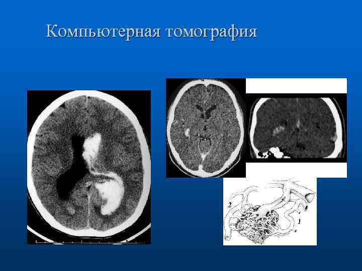 Компьютерная томография 