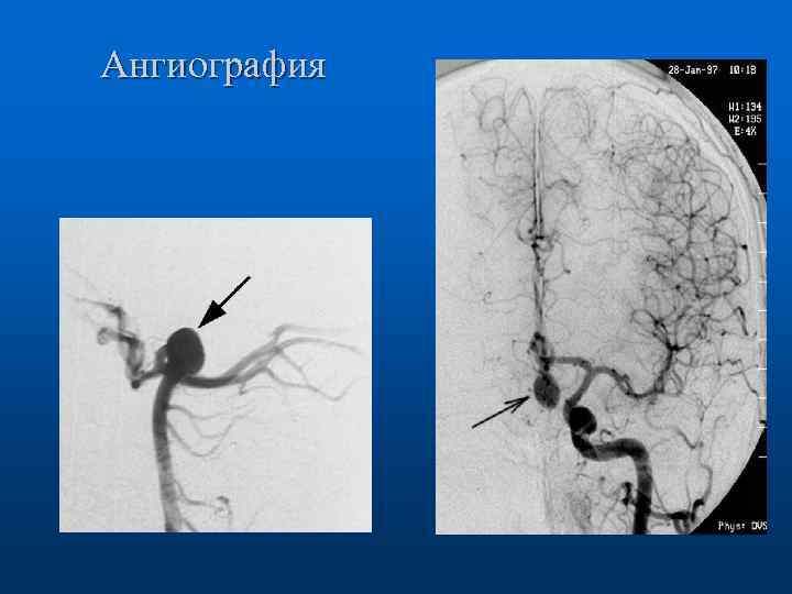 Ангиография 