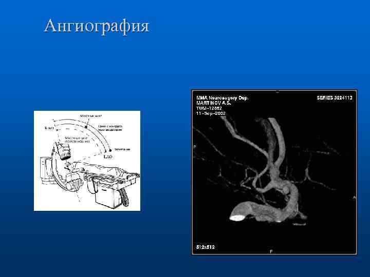 Ангиография 