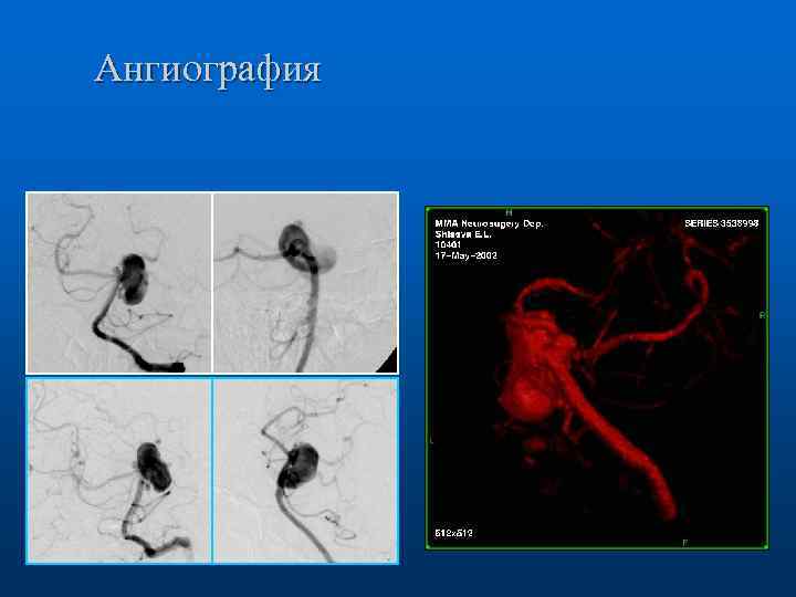 Ангиография 